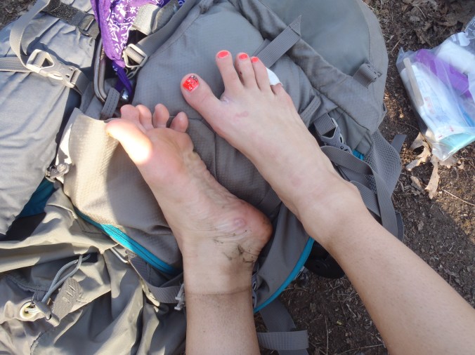 Lindsay's feet after the first 5 days.